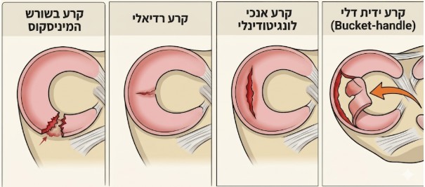 איור המציג ארבעה סוגי קרעים במיניסקוס: ידית דלי, אורכי, רדיאלי, ושורש